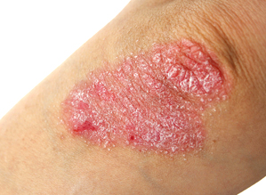 Psoriasis